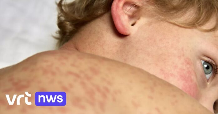 Departement Zorg en CLB's roepen op tot vaccineren tegen mazelen nu 24 Limburgers besmet zijn: